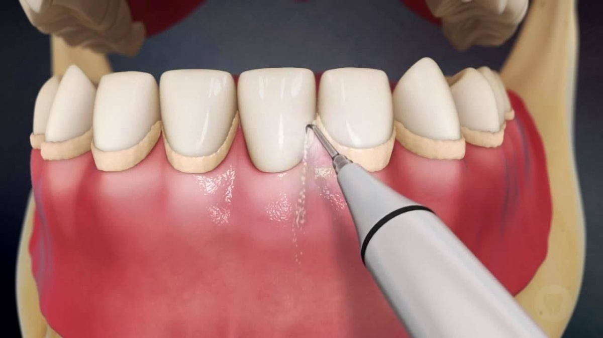 Бесплатную профгигиену полости рта будут проводить стоматологи ННГУ с 18 сентября - фото 1